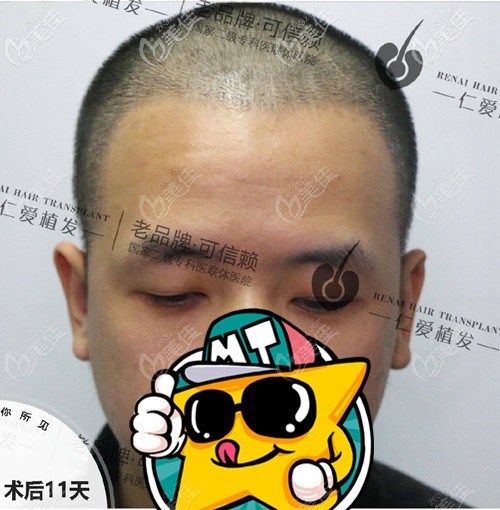 發(fā)際線種植術(shù)后11天效果圖 發(fā)際線種植術(shù)后11天效果圖