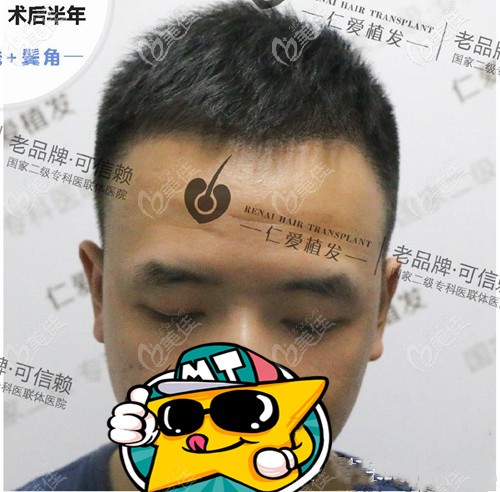 你們猜我在做的m發(fā)際線植發(fā)一次多少錢?順便展示下種植1000個(gè)毛囊面積圖片