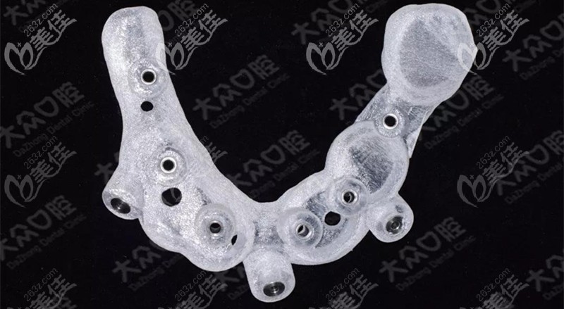 打印完成的上頜種植導(dǎo)板