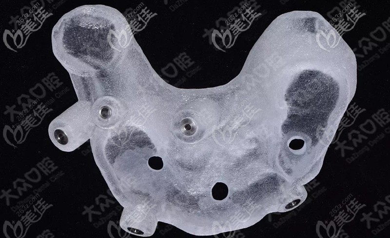 這是打印完的下頜骨種植導(dǎo)板