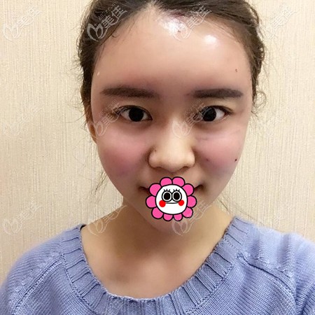 面部脂肪填充后臉有點(diǎn)腫 面部脂肪填充后臉有點(diǎn)腫