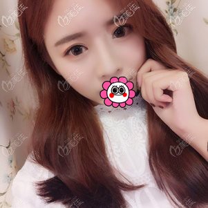 面部脂肪填充恢復(fù)兩個(gè)月案例 面部脂肪填充恢復(fù)兩個(gè)月案例