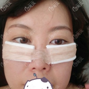 剛做完內(nèi)切祛眼袋手術有點腫脹 剛做完內(nèi)切祛眼袋手術有點腫脹