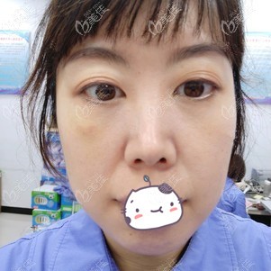 不明白為什么有人做內(nèi)切祛眼袋會后悔 反正我割眼袋10天后效果挺明顯的