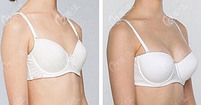 溫州芘麗芙自體脂肪隆胸案例