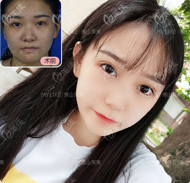 佛山美萊整形醫(yī)院雙眼皮效果圖