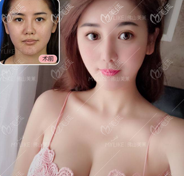 佛山美萊王燕做的雙眼皮效果圖