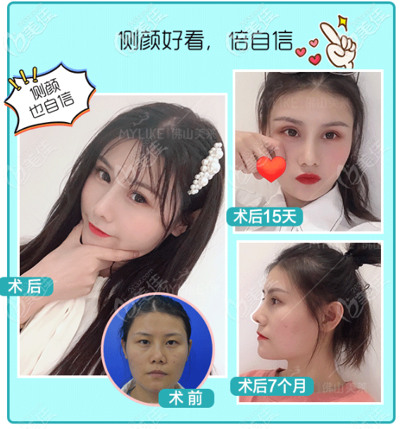 佛山美萊王燕雙眼皮隆鼻效果圖