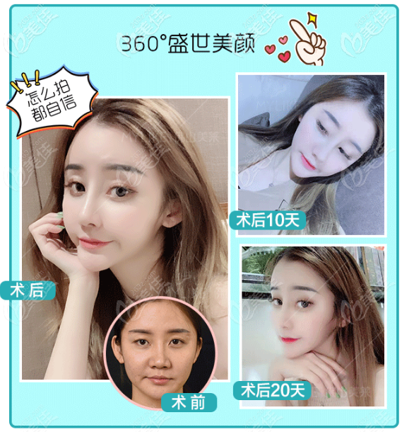 佛山美萊王燕鼻綜合隆鼻效果圖