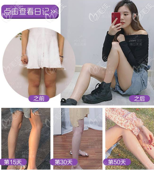 佛山美萊大腿吸脂效果圖