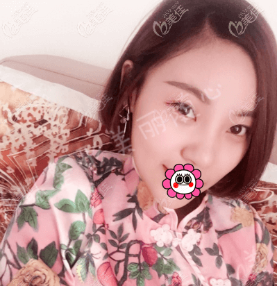 北京畫美徐學(xué)東耳軟骨+硅膠假體綜合隆鼻<span style=