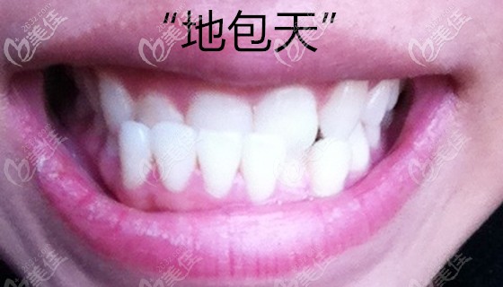 兒童地包天示意圖 兒童地包天示意圖