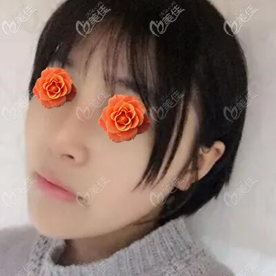 做肋軟骨鼻綜合術(shù)后2個(gè)月恢復(fù)效果照 做肋軟骨鼻綜合術(shù)后2個(gè)月恢復(fù)效果照