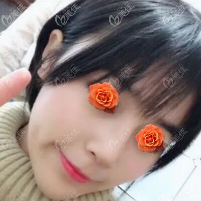 3個月前聽朋友說沈陽美萊口碑還不錯于是我找張晨做了肋軟骨鼻綜合術(shù) 恢復(fù)效果真好！