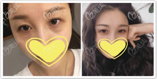 激光熱熔祛眼袋恢復(fù)一個月效果對比圖 激光熱熔祛眼袋恢復(fù)一個月效果對比圖