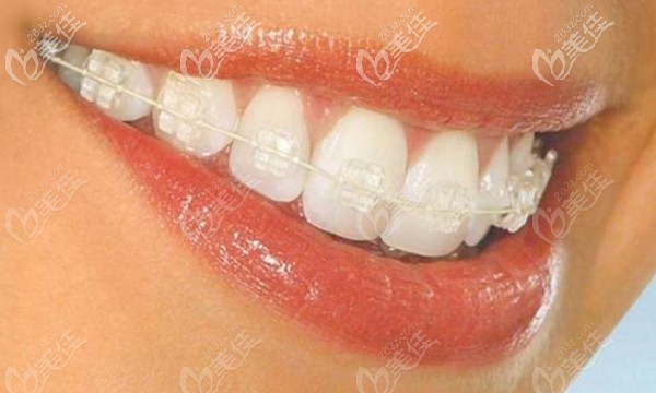 陶瓷托槽矯正器 陶瓷托槽矯正器