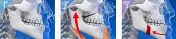 正頜正畸聯(lián)合治療