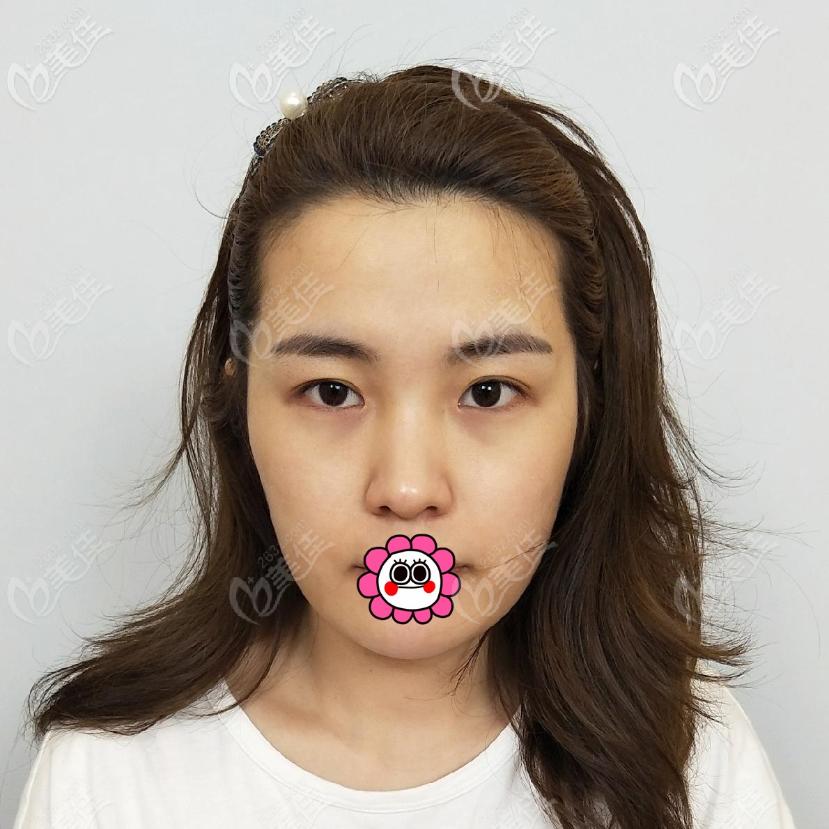 到嘉興禾美找趙學燕做雙眼皮前 到嘉興禾美找趙學燕做雙眼皮前