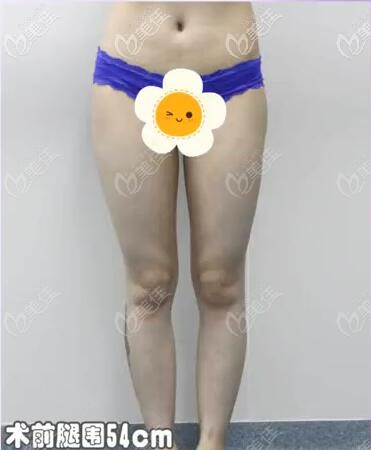 成都艾米麗大腿吸脂術(shù)前照片