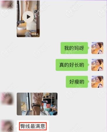 珂珂大腿吸脂術(shù)后真是反饋