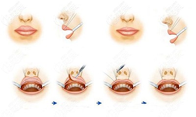 厚唇改薄手術(shù)的原理 厚唇改薄手術(shù)的原理