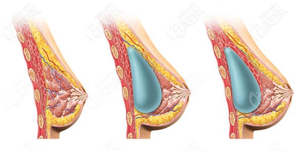 做假體隆胸手術(shù) 做假體隆胸手術(shù)