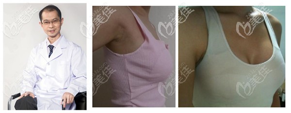 徐建國(guó)美容整形做隆胸手術(shù)實(shí)例 徐建國(guó)美容整形做隆胸手術(shù)實(shí)例