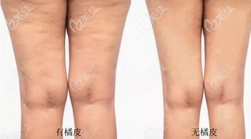 有無橘皮的對比 有無橘皮的對比