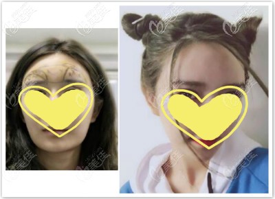 額頭脂肪填充過量做皮層光焊脂肪修復(fù)術(shù)三個月效果圖片 額頭脂肪填充過量做皮層光焊脂肪修復(fù)術(shù)三個月效果圖片