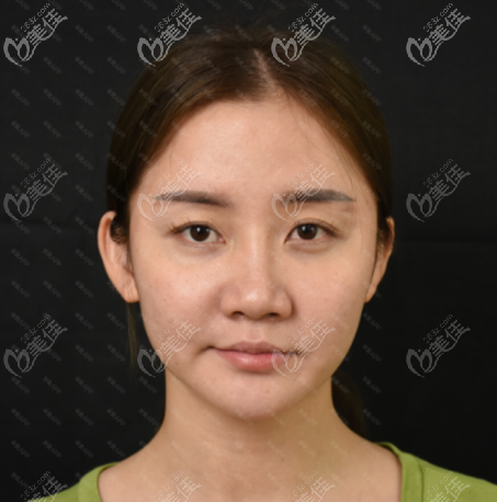 去佛山美萊找王燕醫(yī)生整鼻子術(shù)前照片 去佛山美萊找王燕醫(yī)生整鼻子術(shù)前照片