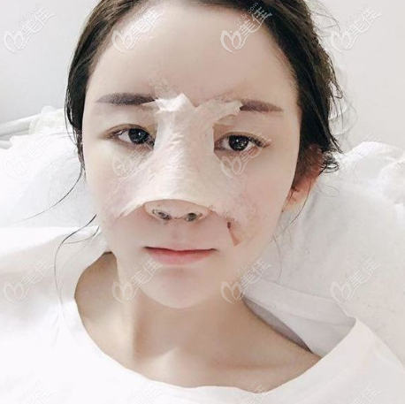 做完鼻綜合隆鼻5天恢復期效果圖 做完鼻綜合隆鼻5天恢復期效果圖