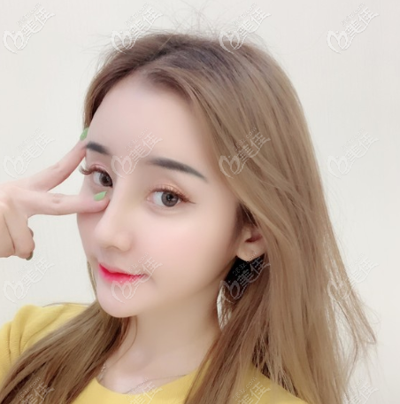 很滿意佛山美萊王燕醫(yī)生給我做的鼻子啊 很滿意佛山美萊王燕醫(yī)生給我做的鼻子啊