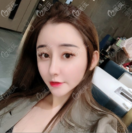 因?yàn)楹軡M意佛山美萊王燕醫(yī)生給我做的鼻子所以雙眼皮隆胸也在他家做的很靠譜