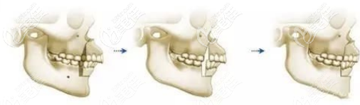 上下頜手術(shù)矯正