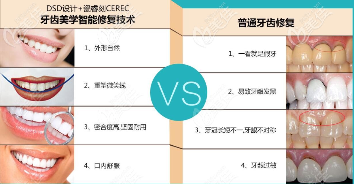 DSD美學修復和普通牙齒修復差別是很大的 DSD美學修復和普通牙齒修復差別是很大的