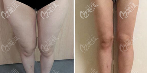 廣州曙光大腿吸脂案例 廣州曙光大腿吸脂案例