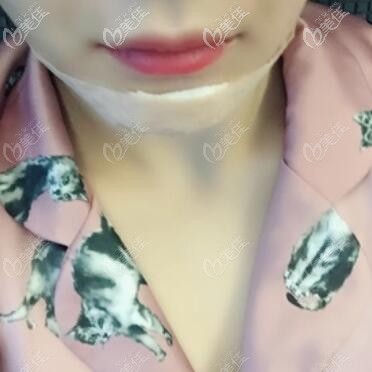 做假體墊下巴手術(shù)當(dāng)天