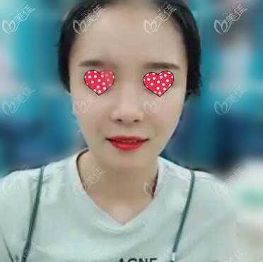 假體墊下巴術(shù)后10天恢復(fù)照