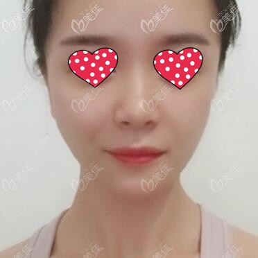 對(duì)比了玻尿酸與假體墊下巴哪個(gè)好后我決定用硅膠假體，已經(jīng)20天了給大家看下效果怎么樣