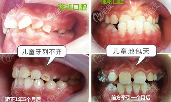 周瑾帆醫(yī)生的兒牙矯正案例 周瑾帆醫(yī)生的兒牙矯正案例
