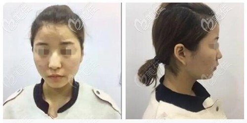 鼻綜合手術(shù)前 鼻綜合手術(shù)前