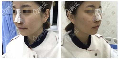 鼻綜合術(shù)后效果 鼻綜合術(shù)后效果