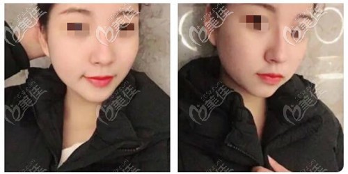 鼻翼縮小外切12天 鼻翼縮小外切12天