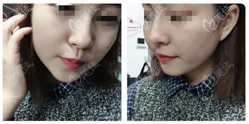 鼻綜合恢復(fù)3個(gè)月效果 鼻綜合恢復(fù)3個(gè)月效果