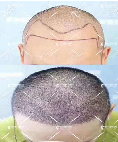 菏澤華美發(fā)際線種植15天效果圖