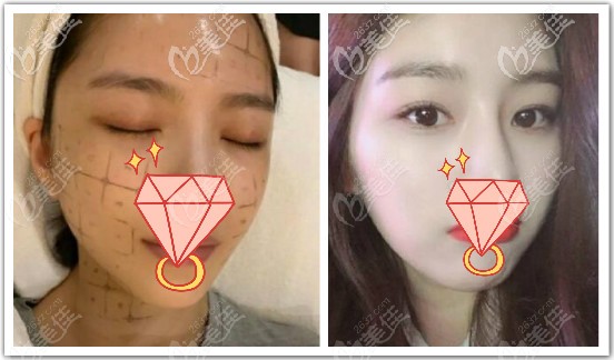 熱瑪吉全臉一年效果圖片 熱瑪吉全臉一年效果圖片