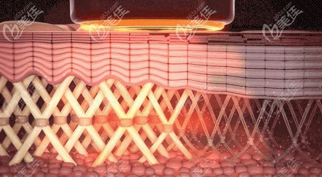 熱瑪吉作用原理介紹 熱瑪吉作用原理介紹