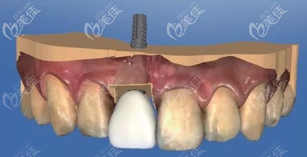 前牙區(qū)的種植示意圖 前牙區(qū)的種植示意圖