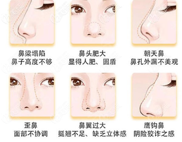 哪些鼻子需要整形 哪些鼻子需要整形