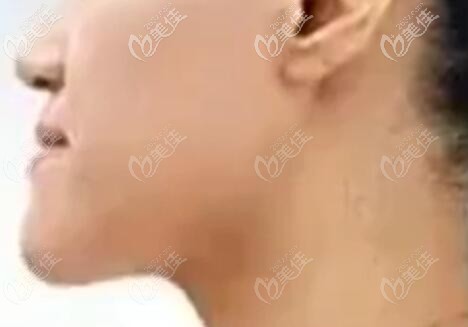 我的骨性地包天臉型圖